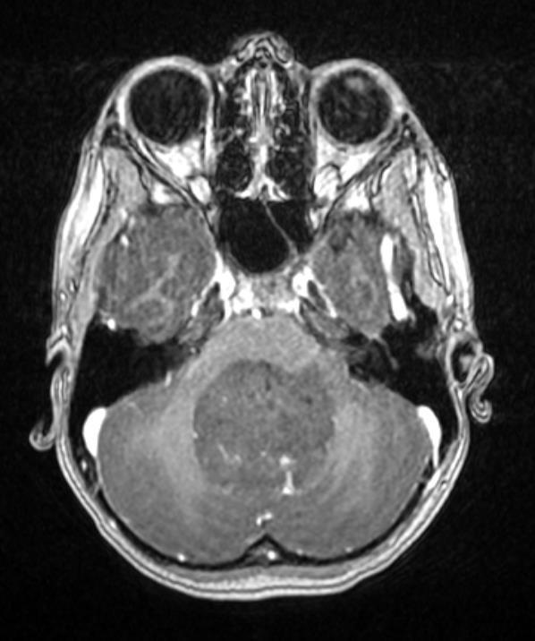 A B MRI images of a 6-year old boy who underwent surgery for a cerebellar medulloblastoma and who developed CMS after an interval of