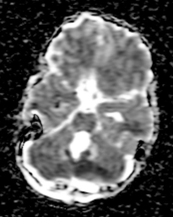 Image B shows a gross total resection of the tumour and slight oedema in the cerebellar white matter, more on the right than on the