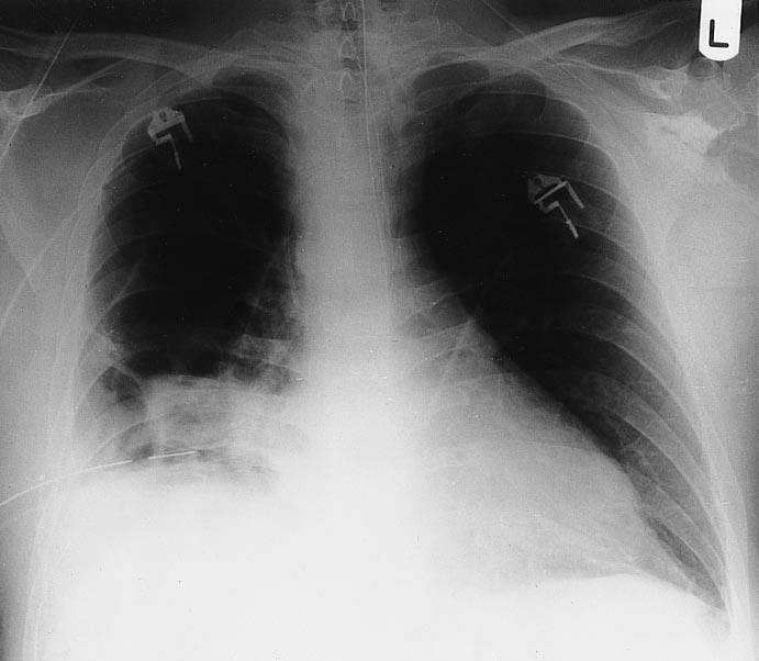 streptokinasebehandeling en spoeling met fysiologisch zout: de