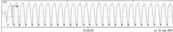 Ventrikeltachycardie (VT) Frequentie 200 per minuut QRS duur > 0,14 sec Monomorf Bij ieder ritmeverandering de