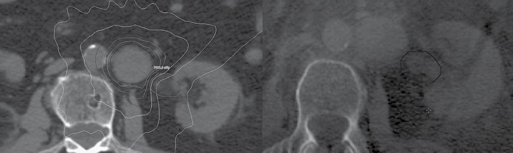 A B Figuur 1. Stereotactische radiotherapie voor een solitaire FDG-PET-positieve para-aortale lymfekliermetastase na een eerdere nefrectomie rechts (1A).