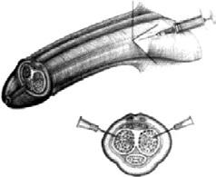 PATIËNTENINFORMATIE Soms is het onvermijdelijk dat deze zenuwen tijdens de operatie moeten worden weg genomen. Het krijgen van een normale erectie is dan niet meer (goed) mogelijk.