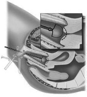 De baarmoederhals wordt dan plaatselijk verdoofd met een dunne naald. Dat kan even pijnlijk zijn. Tevens wordt de baarmoederhals gekleurd met een azijnoplossing of jodium.