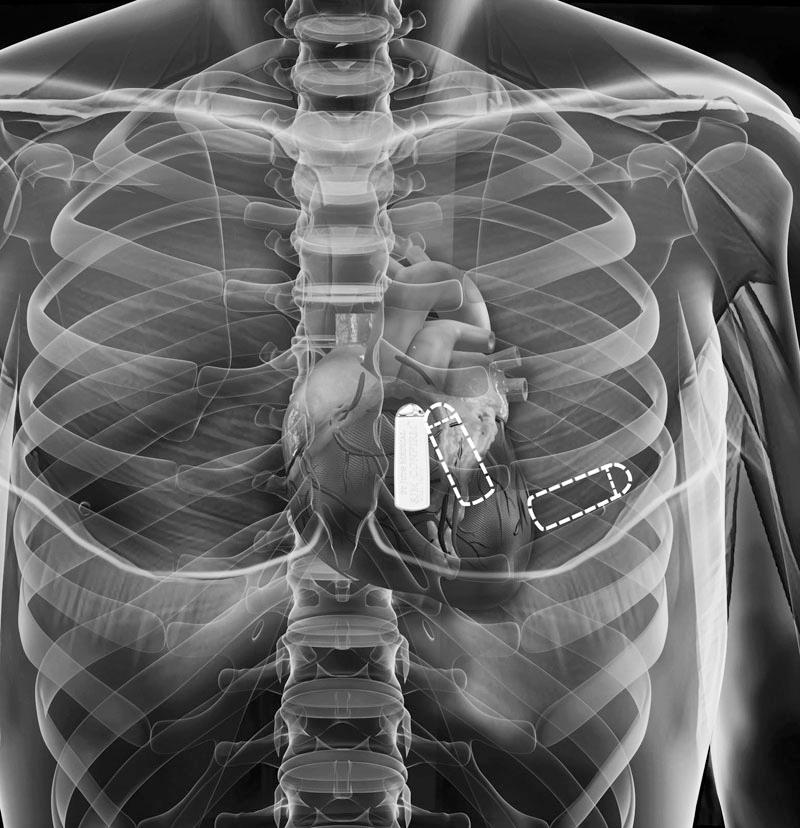 Kiezen van implantatieplaats Plaatsbepaling in het algemeen Mapping kan nuttig zijn om de beste locatie voor de ICM vast te stellen op basis van R-golfmetingen aan de oppervlakte.