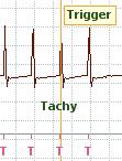 ECG De hartritmeweergave kan maximaal vijf ECG-afleidingen tegelijk weergeven uit zeven mogelijke ECG-vectoren.