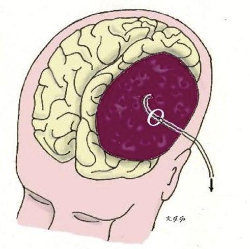 Klein boorgat met drain De neurochirurg maakt bij deze ingreep met een boor een klein gat in uw schedel.