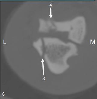 (3) en dorsoplantaire fractuur ter hoogte van de talus (4); L = lateraal, M = mediaal (CT-MR Unit, Vakgroep Medische