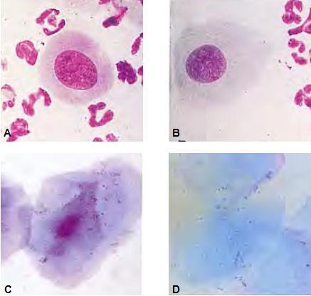 Figuur 6: A. Parabasale cel met meerdere neutrofielen; B. Intermediaire cel met meerdere neutrofielen; C. Gekernde superficiële cel; D. Ongekernde superficiële cel (uit Johnston et al.