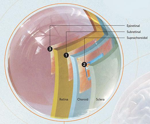 8.5 VERSCHILLENDE TYPEN ELEKTRODEPLATEN, BINNENIN DE OOGBOL De elektrodeplaat kan op verschillende plekken in de oogbol worden geplaatst.