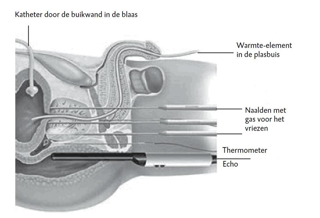 De ingreep duurt ongeveer twee tot drie uur. De uroloog bevriest en ontdooit de prostaat twee tot drie keer. Na de operatie verwijdert de uroloog de naalden.