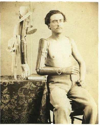Plaat/Plate no Malespine, Man met twee armprotheses naar een ontwerp van de Comte de Beaufort/Man with two arm protheses after a