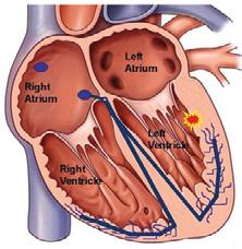 Deze hartritmestoornis kan paroxysmaal optreden waarbij aanvallen van VKF spontaan komen en weer verdwijnen.