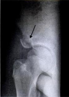 Avulsiefractuur Zeldzame gevallen Echter, zeer belangrijk in DD bij atypische klachten! Casus Avulsiefractuur van Spina Iliaca Anterior Inferior Launay F.