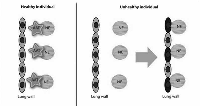 Astma en COPD Astma en COPD In theorie Figuur 8: Alpha-1-antitrypsine beschermt de longweefsels tegen neutrofiel elastase.