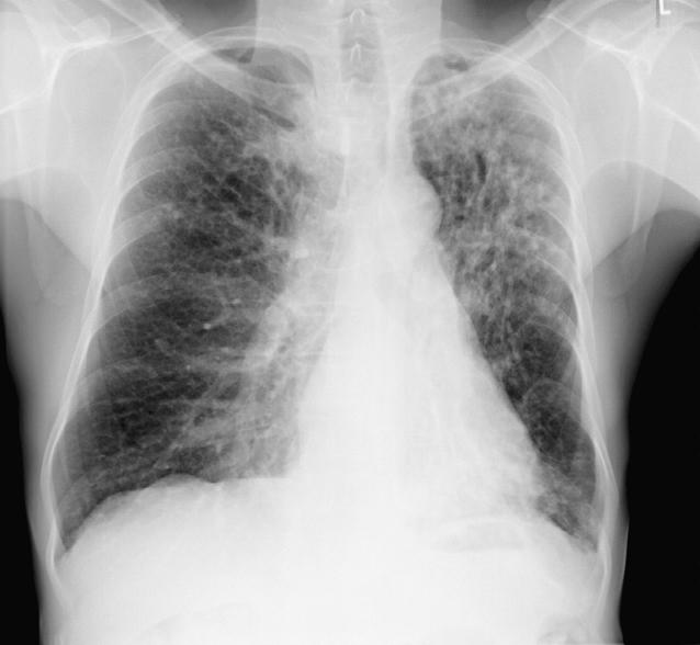 met beginnende holtevorming R L figuur 1. Röntgenfoto van de thorax van patiënt A met uitgebreide in de linker en de rechter bovenkwab, alsmede in de linker onderkwab; er is beginnende holtevorming.
