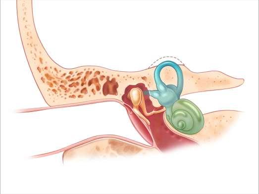 Vertigo superior semicircular canal dehiscence Horen bewegen van eigen oogbollen