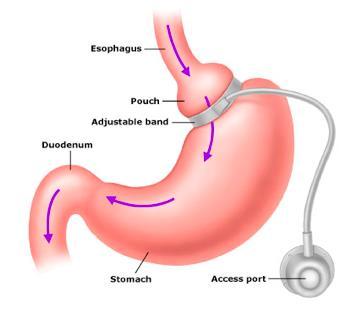 Mechanismen die absorptie verstoren Gastric