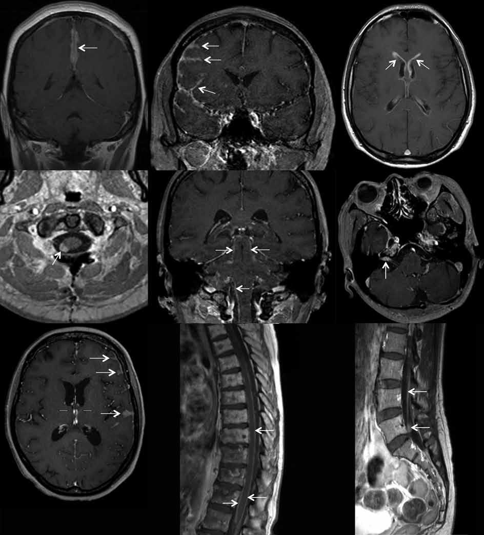 A B C D E F G H I Figuur 2. Directe MRI-kenmerken van leptomeningeale metastasen op T1-gewogen MRI met gadolineum. A. Durale aankleuring van de falx. B. Leptomeningeale aankleuring in de rechterhemisfeer.