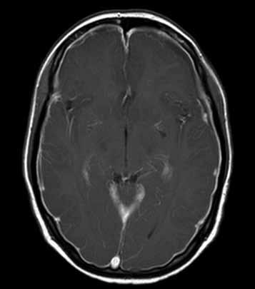 Transversale T1-gewogen MRI-opname met gadolineum: zeer twijfelachtige leptomeningeale aankleuring in de folia van het cerebellum. B.