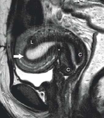 Adenomyosis