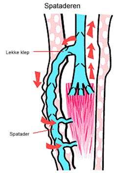 Spataderen zijn abnormaal verwijde, gekronkelde aderen in de benen (zie figuur 2 en 3).