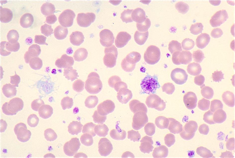 Afwijkende thrombopoïese Reuzethrombocyten: Thrombocytose : Inflammatoir