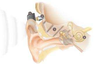 HOORIMPLANTAAT Bone Anchored Hearing Aid (BAHA) Bron: www.cochlear.