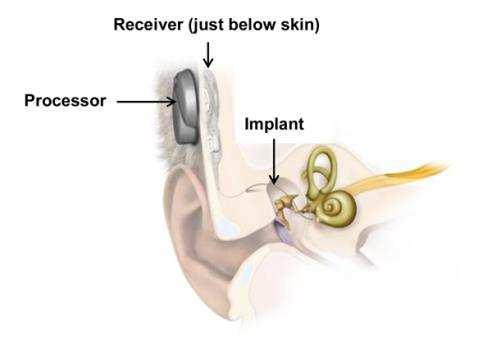 HOORIMPLANTAAT Middenoor implantaat (MEI: Middle Ear Implant) Bron: www.medel.