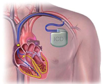 Defibrillator Tijdens de ingreep wordt de defibrillator onder de huid boven de linkerborstspier geïmplanteerd. De huid onder het sleutelbeen wordt over ongeveer 5 cm ingesneden.