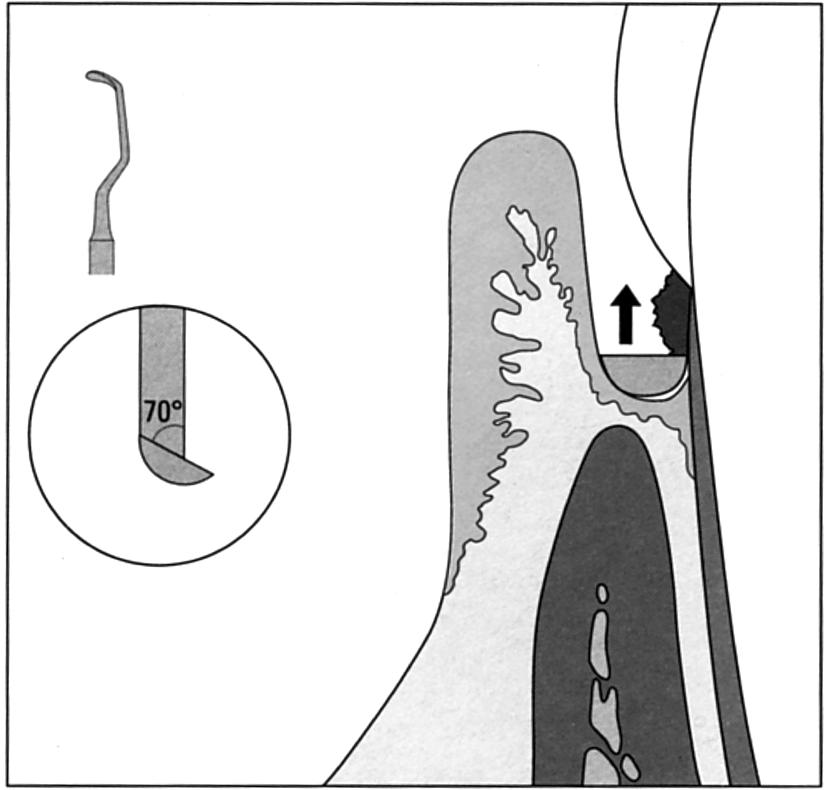 verkregen van de gezondheidstoestand van het parodontium. Met een curette worden epitheel en bindweefselresten uit de pocket verwijderd.