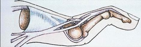 Klachten Bij een mallet vinger kunt u last hebben van onderstaande klachten: Een pijnlijke en afhangende vingertop die niet gestrekt kan worden.