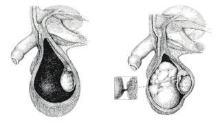 Spermatocele Spermatocele ontstaat vanuit de bijbal. Het zaadvocht dat in de zaadbal wordt gevormd, wordt naar de bijbal getransporteerd waar verdere rijping plaatsvindt.