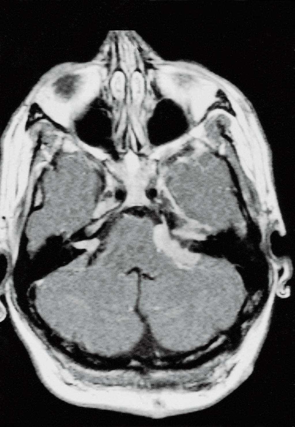 schwannoom meningeoom figuur 2. Transversale MRI-opname (T1-gedomineerd) van de schedelbasis van patiënt D na toediening van gadoliniumcontrastmiddel.
