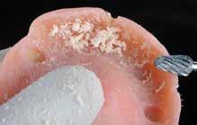 van de patiënt. Dit kan aan de hand van een relining-materiaal om wonden in het zachte weefsel en ongemakkelijke tandbewegingen te voorkomen tijdens het kauwen.