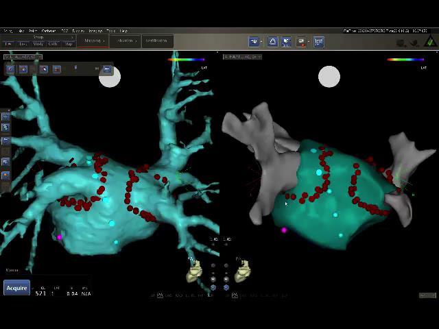 Focal Atrial