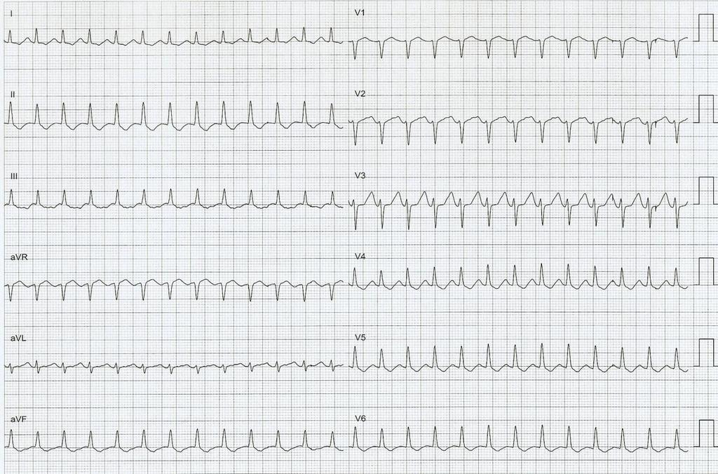 Atrio-Ventriculaire Reëntry Tachycardie Smal QRS tachycardie met morfologie QRS = sinus