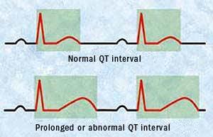 Lang QT syndroom Verlenging van het QT