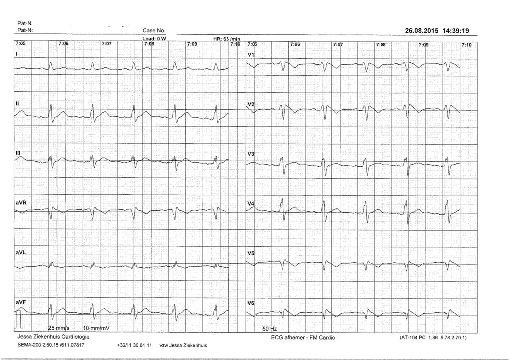 ECG suggestief voor Brugada syndroom Onvolledig Re Bundeltakblok