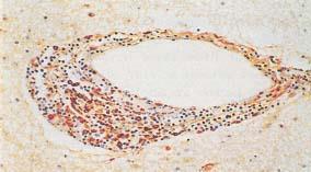 Demyelination Axonal Loss Trapp