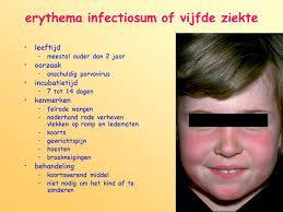 5e ziekte in kinderdagverblijf Kind met 5e ziekte (erythema infectiosum, parvo