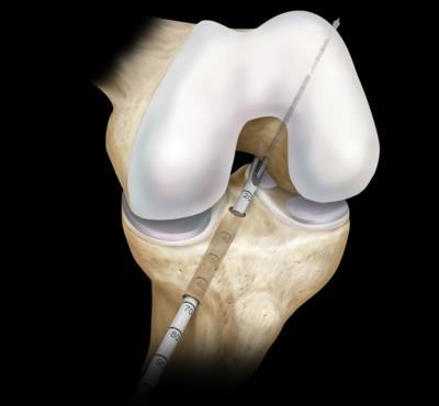 BIOMECHANICA VAN HET KNIEGEWRICHT Figuur 5.1: Links: non-anatomische dubbele- bundelreconstructie met 1 tibiale en 2 femorale bevestigingen.