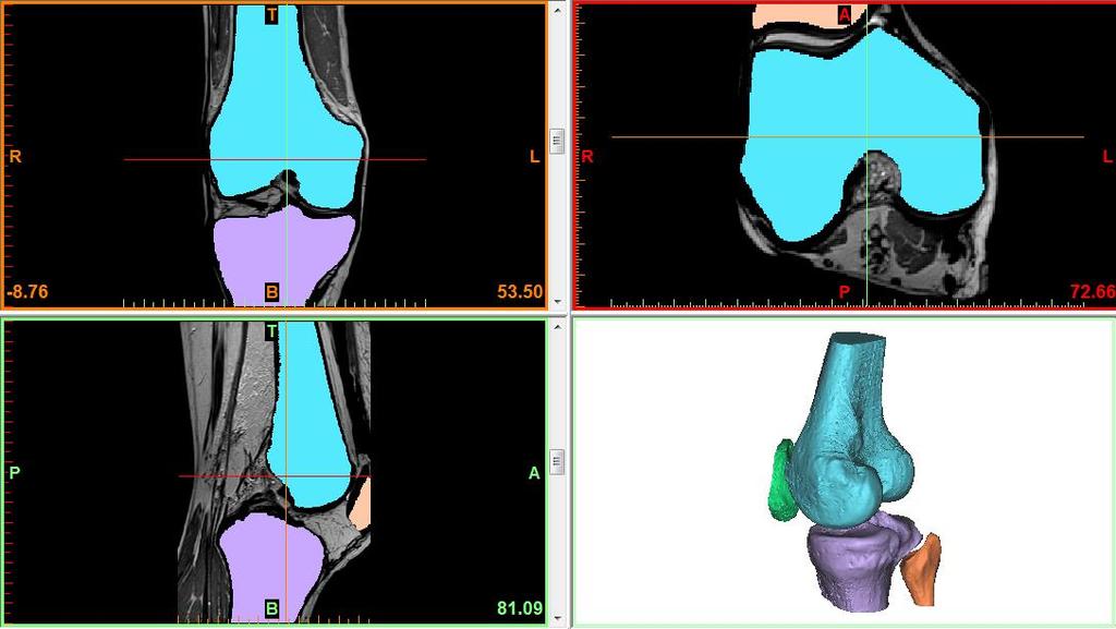 BIOMECHANICA VAN HET KNIEGEWRICHT 6.1 Botten Eerst worden de vier botten gesegmenteerd.