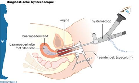 U ondergaat een diagnostische hysteroscopie. Dit is een onderzoek waarbij de gynaecoloog met een dun buisje in de baarmoeder kijkt en eventueel kleine ingrepen doet.