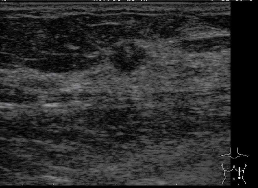 a b lokalisatiedraad FIGUUR 3 Echografisch beeld van (a) de linker mamma van patiënt B, met een ongeveer 6 mm grote echoarme afwijking; (b) het operatiepreparaat; zowel in sagittale richting (hier