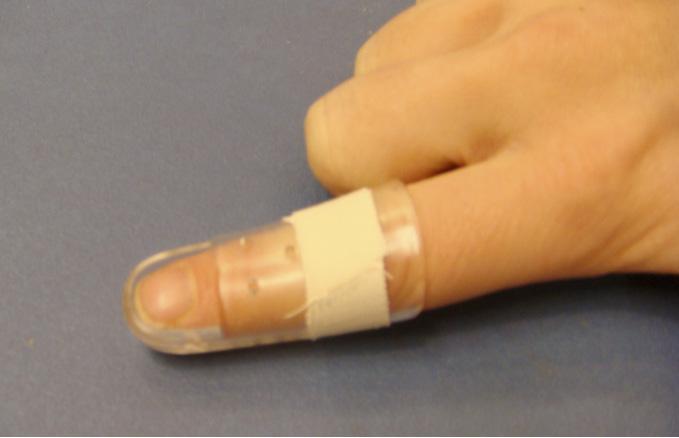Oorzaak De meeste voorkomende oorzaak is het stoten van het topje van de vinger in gestrekte toestand. Dit kan gebeuren tijdens het sporten door bijvoorbeeld een bal of bij het opmaken van het bed.