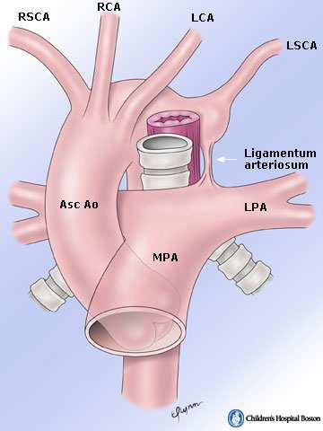 The posterior esophagus and anterior trachea are encircled by a vascular ring that is completed by the ligamentum arteriosum.