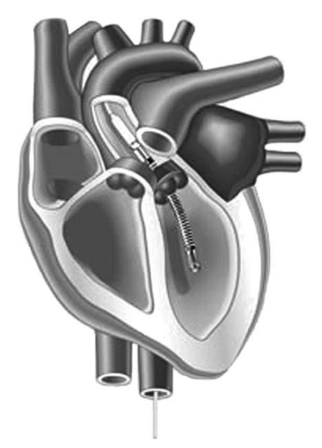Impella voor het beschadigde hart Welke techniek? Het Impella systeem is een nieuwe techniek voor mechanische ondersteuning van de pompfunctie van het hart.