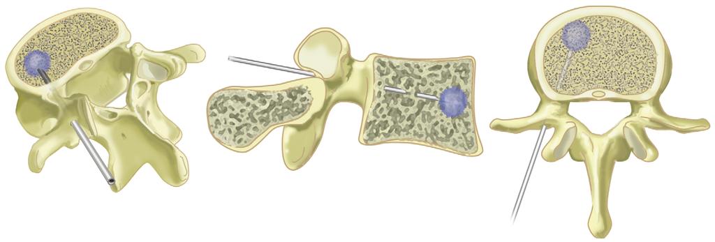 internist, 1 patiënt kwam via de orthopedisch chirurg. Het betrof 14 vrouwen en 4 mannen, met een gemiddelde leeftijd van 75 jaar (uitersten: 63-87).