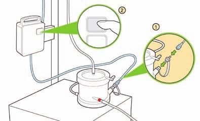 Stap 9 De infuuspomp aansluiten en pompen met een snelheid van 30 ml/uur Verwijder de dop van de poort voor de afdichtingsspoeling op de Hemolung-cartridge en bevestig de keerklep vervolgens aan de