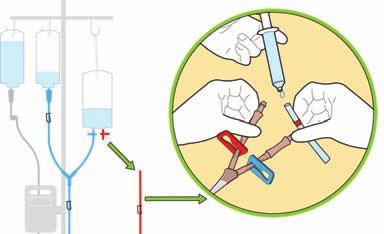 Wees extra voorzichtig bij het hanteren van de bloedslang rond de katheterverbinding.